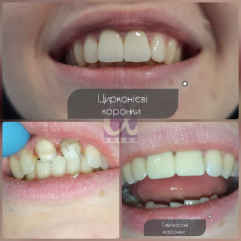 Зміна посмішки з використанням 2-ох одиниць цирконію (безметалева конструкція)
   стоматологія