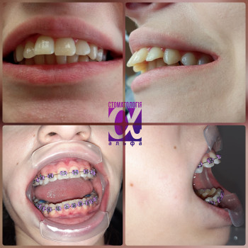 Дистальний прикус.
Постановка брекет системи.
  