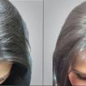 Мезотерапія шкіри голови
                    Косметологический центр Нью Медикал Киев