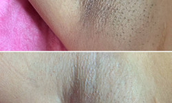 Лазерная эпиляция Студия лазерной эпиляции Luxor Днепр