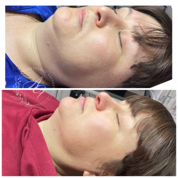 Робота непрямими ліполітиками в зоні підборіддя