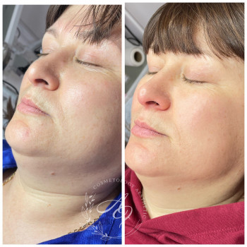 Робота непрямими ліполітиками в зоні підборіддя