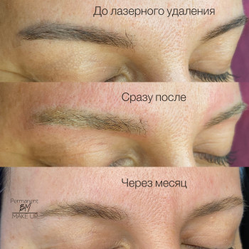 Удаление татуажа, фото - Мастер перманентного макияжа Мария Баранова