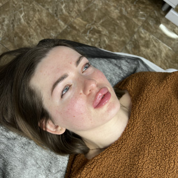 Увеличение губ
                    Косметолог Екатерина Киев