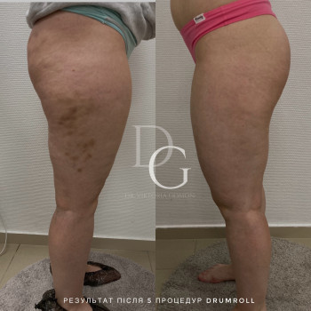 DrumRoll. Ударно-імпульсний вакуумний термомасаж
                    Косметологический центр Dr. Gomon Cosmetology Черкассы