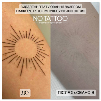 удаление тату