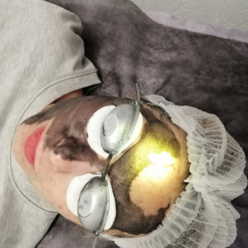 Карбоновый пилинг