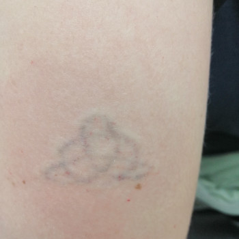 Удаление татуировок