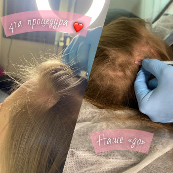 Мезотерапія волосся
                    Косметолог-инъекционист Тетяна Бровары