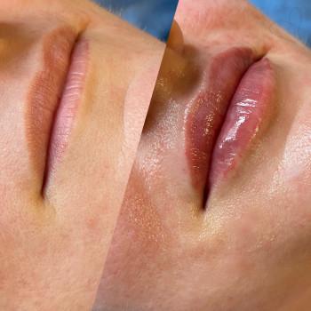 Збільшення губ
                    Косметолог-ін'єкціоніст Тетяна Бровари