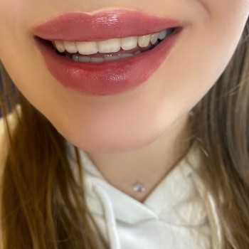 Збільшення губ
                    Косметолог-ін'єкціоніст Тетяна Бровари