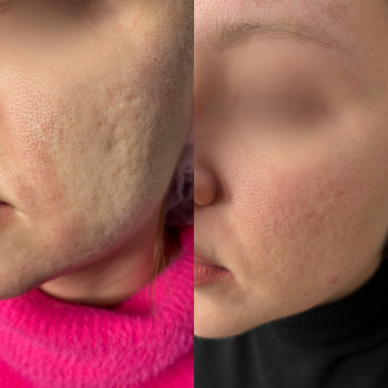 Лечение будет.
3 процедуры и WOW результат?, фото - косметолог-инъекционист Олена Поліщук