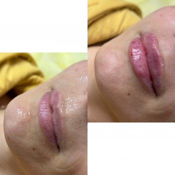 Коррекция губ?, фото - косметолог-инъекционист Олена Поліщук