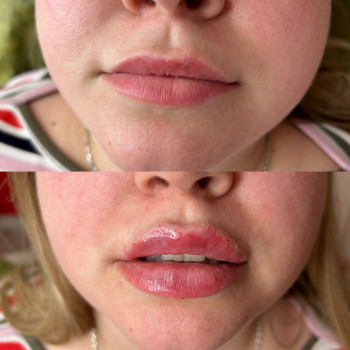 Губи ??, фото - косметолог-инъекционист Олена Поліщук