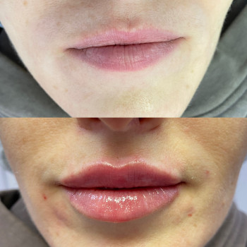 Что-то на идеальном ✨, фото - косметолог-инъекционист Олена Поліщук