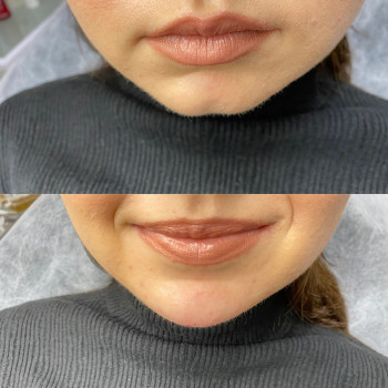 Корекція підборіддя ✨