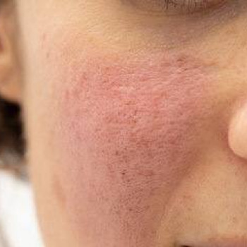 DEKA SYNCHRO FT
                    Студия татуажа Школа-студия Татьяны Поливановой Одесса