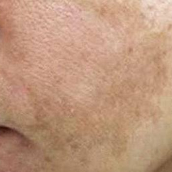 DEKA SYNCHRO FT
                    Студия татуажа Школа-студия Татьяны Поливановой Одесса