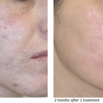 ЛАЗЕРНАЯ ШЛИФОВКА / ФРАКЦИОННЫЙ СО2 ЛАЗЕР DEKA SMARTXIDE DOT
                    Студия татуажа Школа-студия Татьяны Поливановой Одесса