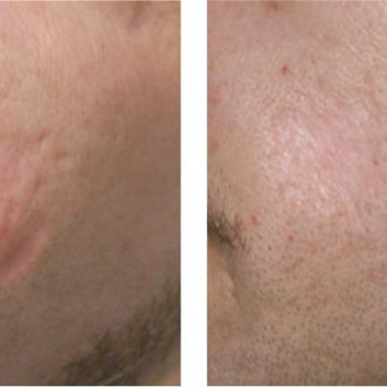 ЛАЗЕРНАЯ ШЛИФОВКА / ФРАКЦИОННЫЙ СО2 ЛАЗЕР DEKA SMARTXIDE DOT
                    Студия татуажа Школа-студия Татьяны Поливановой Одесса