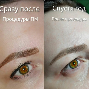 Сразу после процедуры , и спустя год.