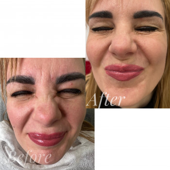 Коррекция носа ботулотоксином
  носу 
 