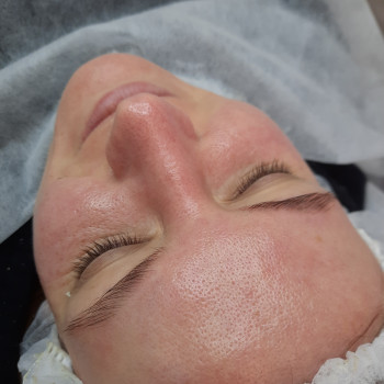 Результат механічної чистки та кислотного пілінгу