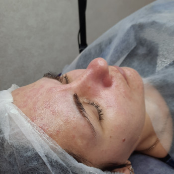 Результат механічної чистки та кислотного пілінгу