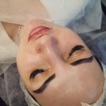 Карбоксітерапія +Кислотний пілінг 
Результат?