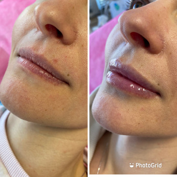 Збільшення губ, натуральний ефект