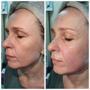 Скульптурний масаж обличчя
                    Салон краси Body and face sculpture Київ