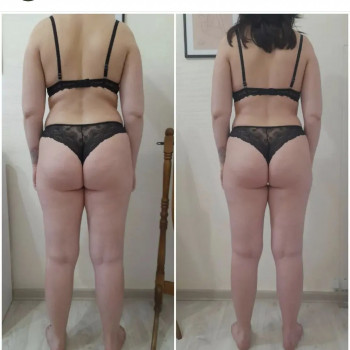 Рф ліфтінг тіла
                    Салон красоты Body and face sculpture Киев