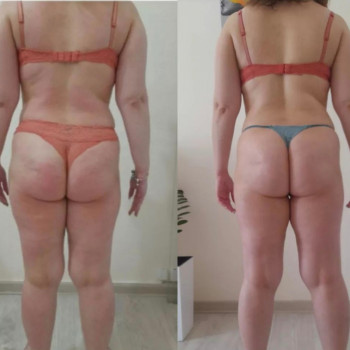 Рф ліфтінг тіла
                    Салон красоты Body and face sculpture Киев