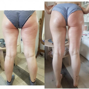 Рф ліфтінг тіла
                    Салон красоты Body and face sculpture Киев