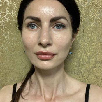 Векторний ліфтинг препаратом Radiesse
                    Врач-косметолог Марина Черкассы