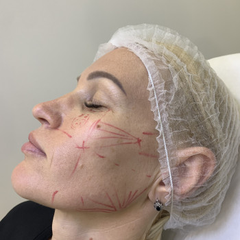 Векторний ліфтинг препаратом Radiesse
                    Врач-косметолог Марина Черкассы