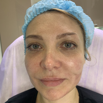 Відразу після процедури Radiesse