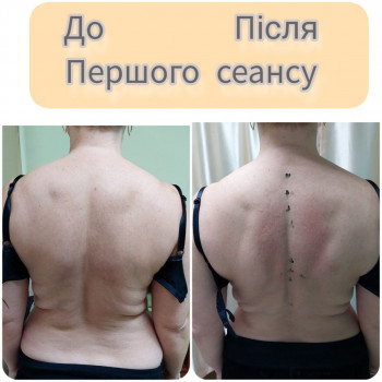 До та після курсу масажів