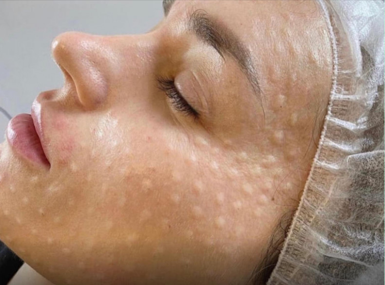 Біоревіталізація
                    Косметологічний центр NuTon Одеса