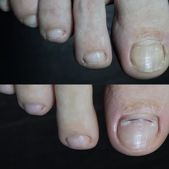 Подологія. Лікування врослого нігтя (система - титанова нитк