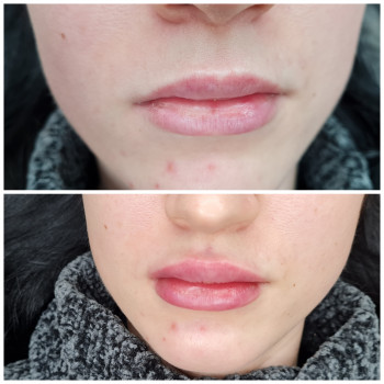 Увеличение губ
                    Майстер перманентного макіяжу Дарина Кривий Ріг