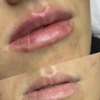 КП губ 1 мл Saypha filler