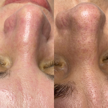 Чистка обличчякомьвнована , пілінг, маска