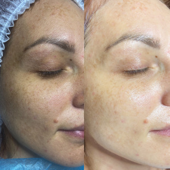 Депігментуючий пілінг