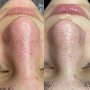 Комбінована чистка обличчя , маска, курс пілінгів