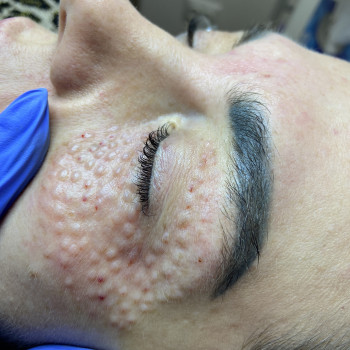 Біоревіталізація зони навколо очей