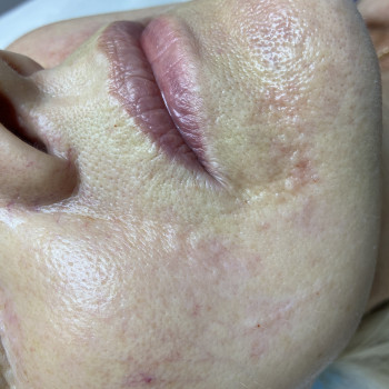 Лікування заломів 
Покращення якості шкіри