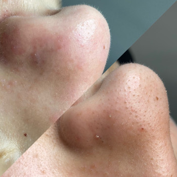 Чистка обличчя