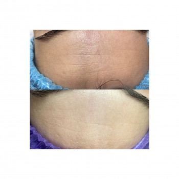 Біоревіталізація