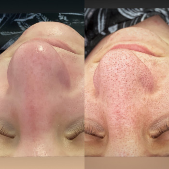 Чистка/курс пілінгів